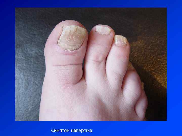 Симптом наперстка 