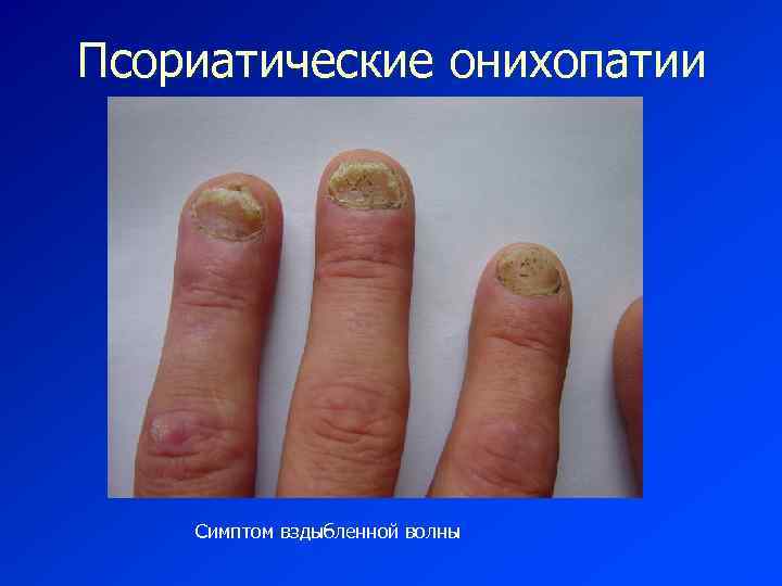 Псориатические онихопатии Симптом вздыбленной волны 