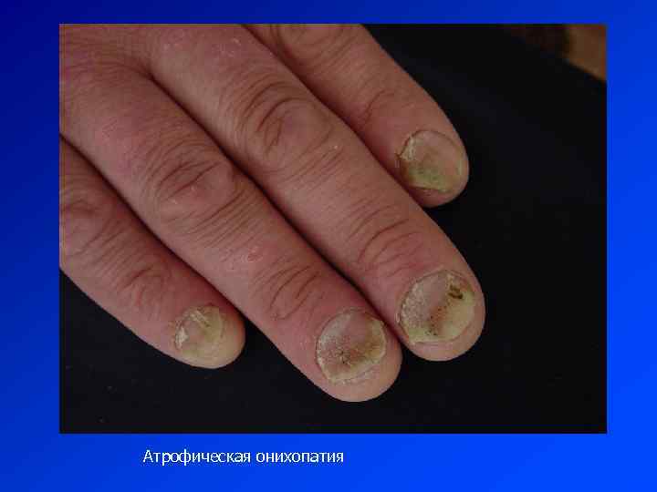 Атрофическая онихопатия 