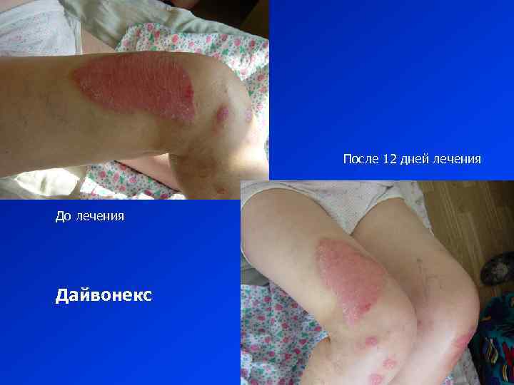 После 12 дней лечения До лечения Дайвонекс 