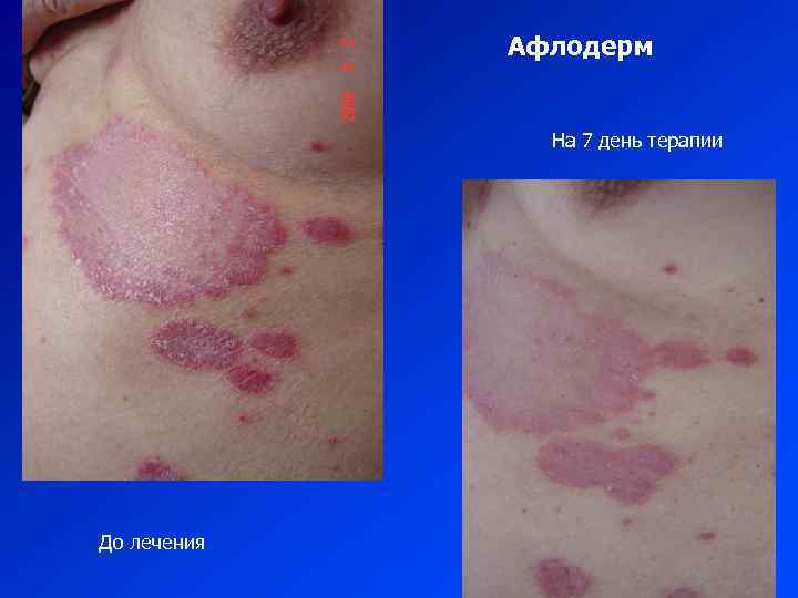 Афлодерм На 7 день терапии До лечения 