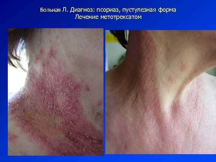 Больная Л. Диагноз: псориаз, пустулезная форма Лечение метотрексатом 
