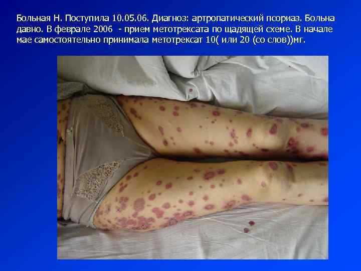 Больная Н. Поступила 10. 05. 06. Диагноз: артропатический псориаз. Больна давно. В феврале 2006