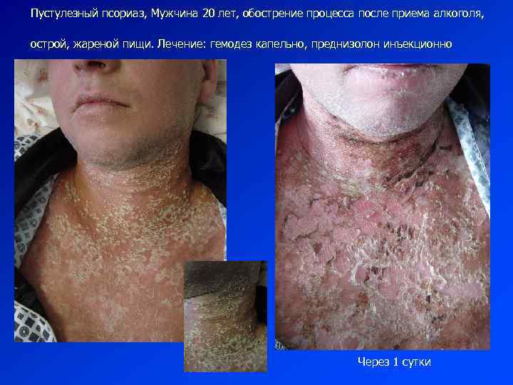 Пустулезный псориаз, Мужчина 20 лет, обострение процесса после приема алкоголя, острой, жареной пищи. Лечение: