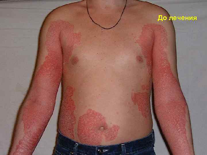 До лечения 