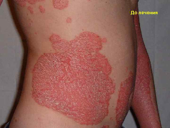 До лечения 