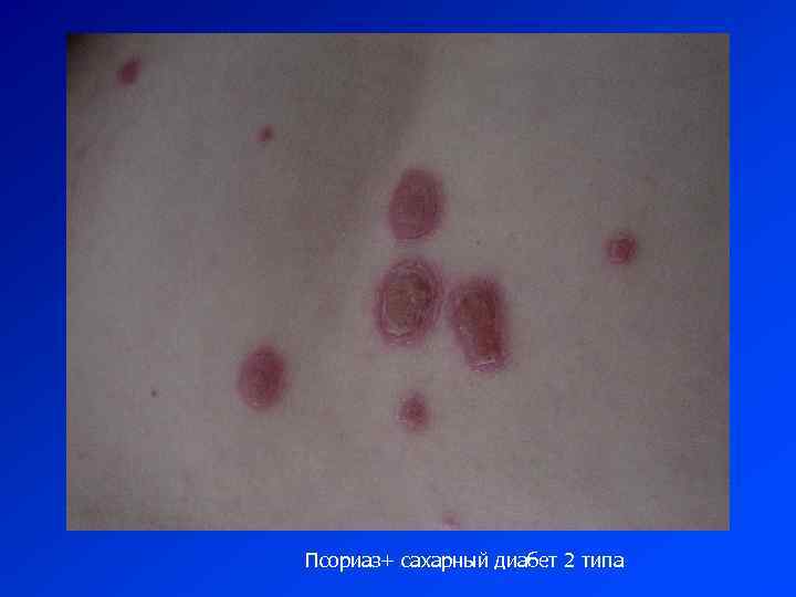 Псориаз+ сахарный диабет 2 типа 