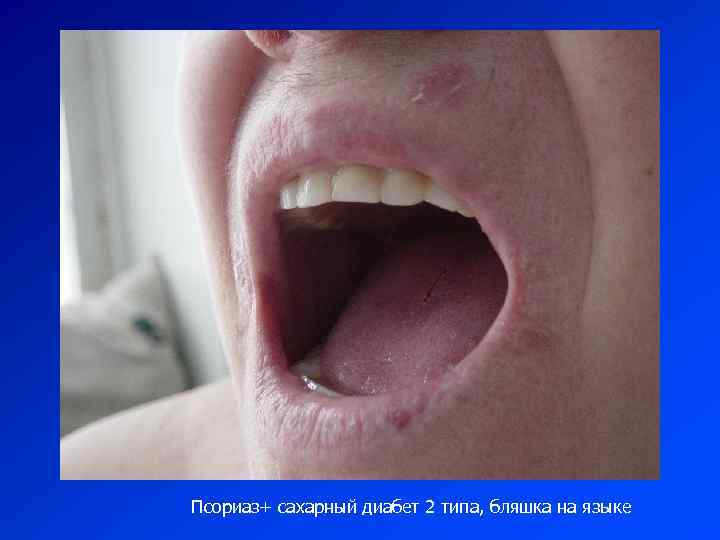 Псориаз+ сахарный диабет 2 типа, бляшка на языке 