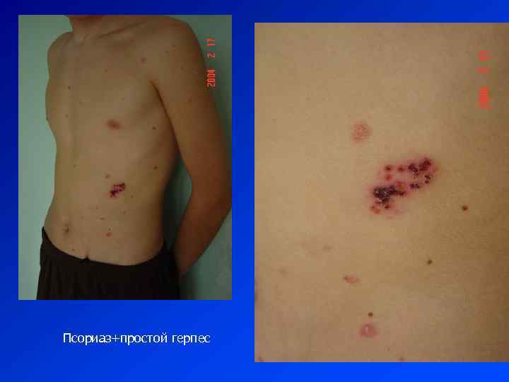 Псориаз+простой герпес 