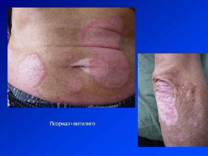 Псориаз+витилиго 