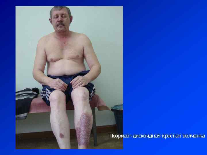Псориаз+дискоидная красная волчанка 