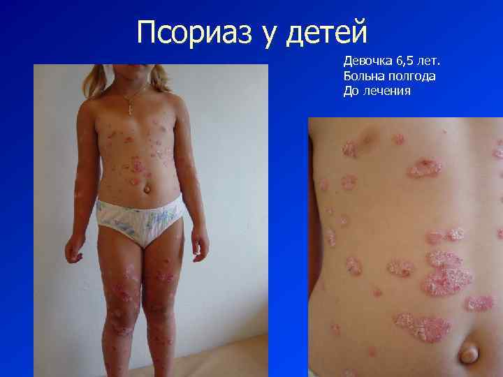 Псориаз у детей Девочка 6, 5 лет. Больна полгода До лечения 