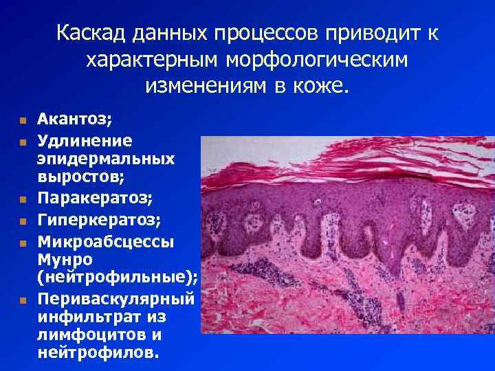Каскад данных процессов приводит к характерным морфологическим изменениям в коже. n n n Акантоз;