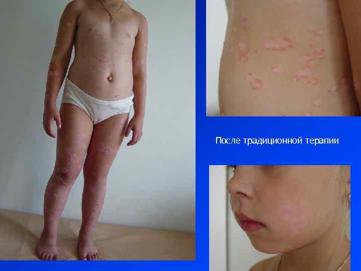 После традиционной терапии 