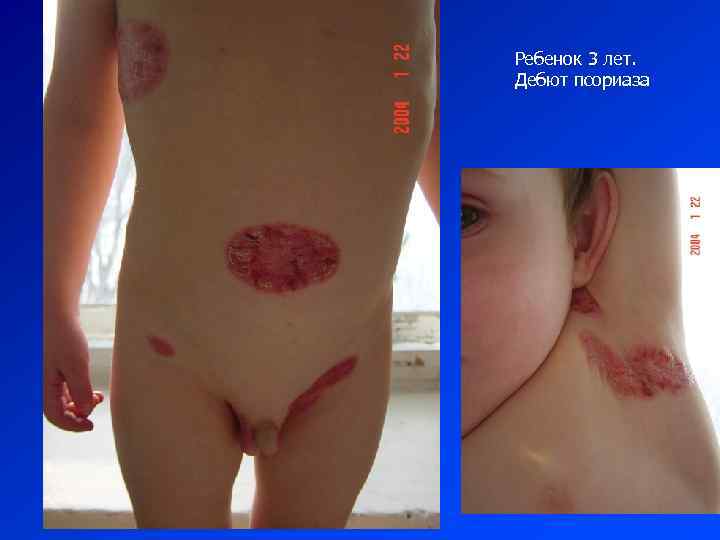 Ребенок 3 лет. Дебют псориаза 