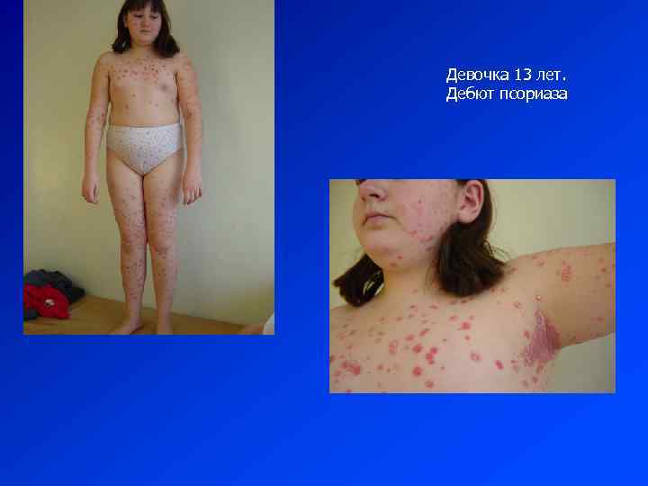 Девочка 13 лет. Дебют псориаза 