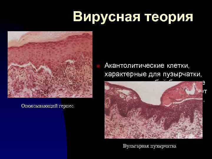 Вирусная теория n Опоясывающий герпес Акантолитические клетки, характерные для пузырчатки, напоминают собой баллонные клетки,