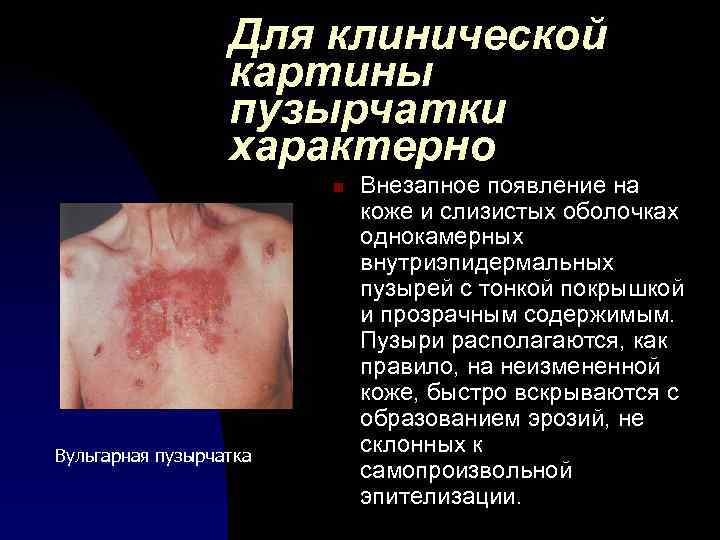Для клинической картины пузырчатки характерно n Вульгарная пузырчатка Внезапное появление на коже и слизистых