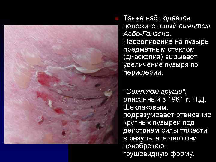 n n Также наблюдается положительный симптом Асбо-Ганзена. Надавливание на пузырь предметным стеклом (диаскопия) вызывает