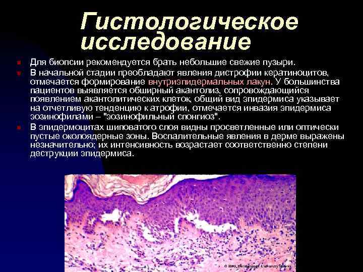 Гистологическое исследование n n n Для биопсии рекомендуется брать небольшие свежие пузыри. В начальной