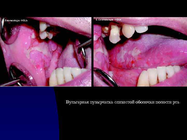 Вульгарная пузырчатка слизистой оболочки полости рта 