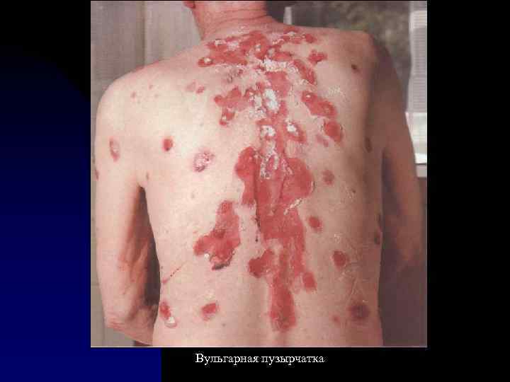 Вульгарная пузырчатка 