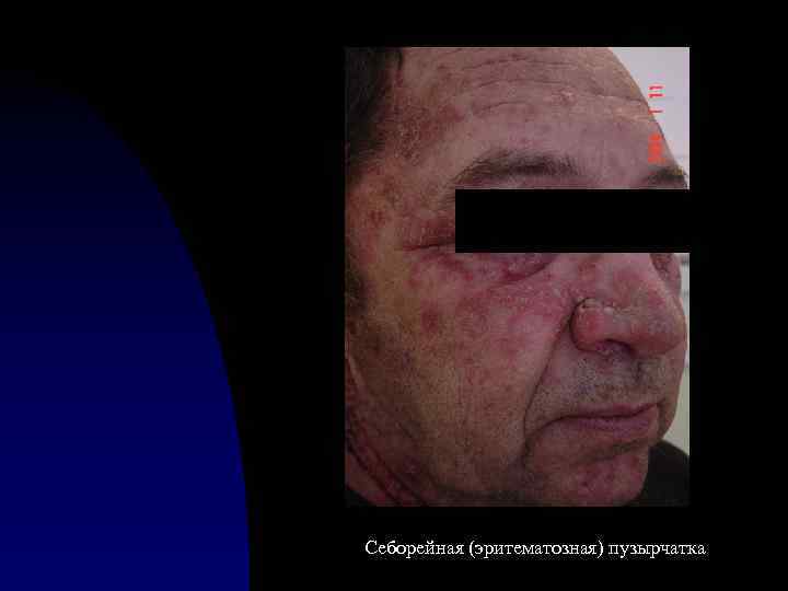 Себорейная (эритематозная) пузырчатка 