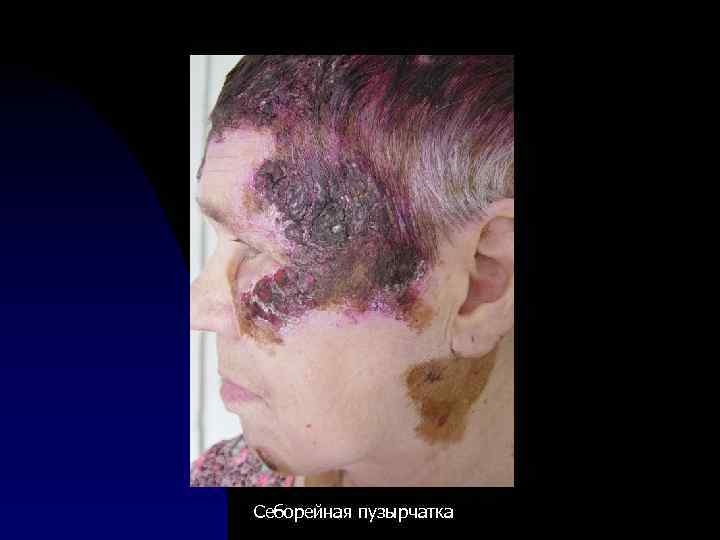 Себорейная пузырчатка 