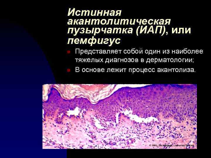 Диагностика пузырчатки. Акантолитические клетки пузырчатки. Акантолитическая (или истинная) пузырчатка. Акантолиз при пузырчатке.