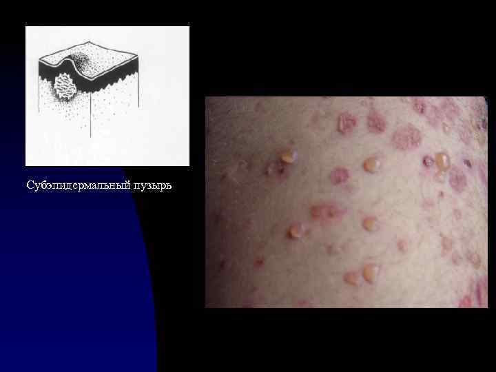 Субэпидермальный пузырь 