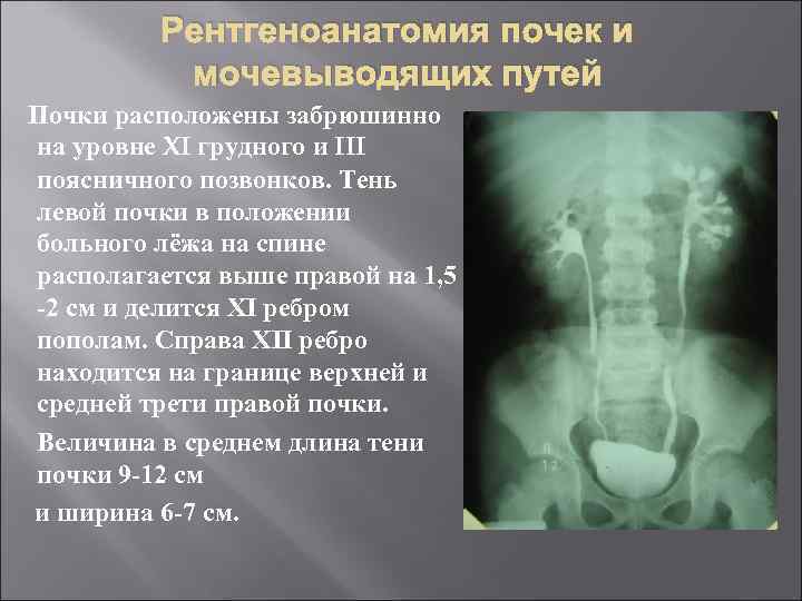 Рентгеноанатомия почек и мочевыводящих путей Почки расположены забрюшинно на уровне XI грудного и III
