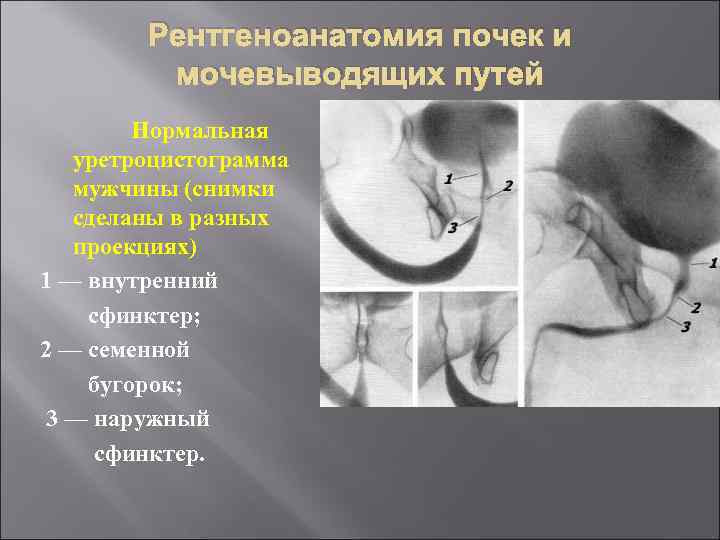 Рентгеноанатомия почек и мочевыводящих путей Нормальная уретроцистограмма мужчины (снимки сделаны в разных проекциях) 1