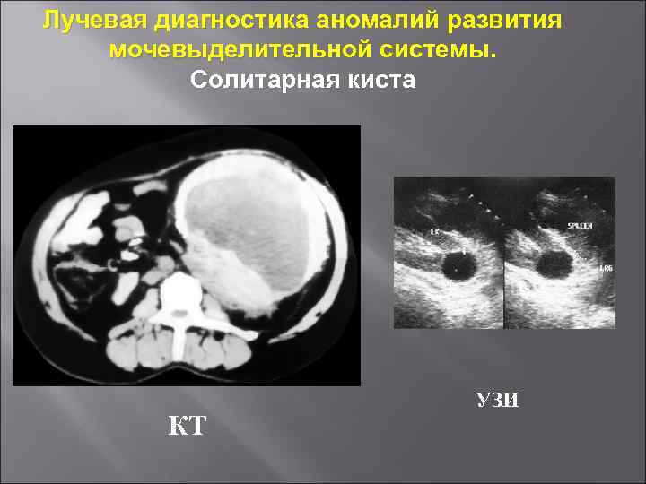 Лучевая диагностика аномалий развития мочевыделительной системы. Солитарная киста КТ УЗИ 