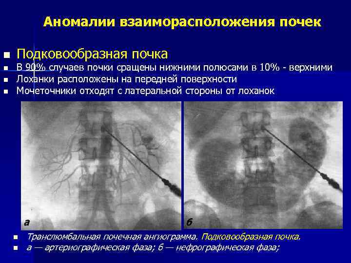 Подковообразная почка на узи фото