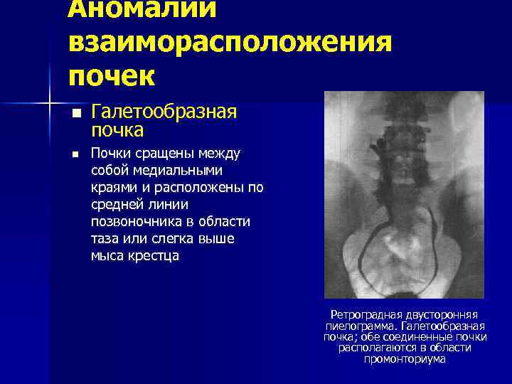 Аномалии развития почки картинки