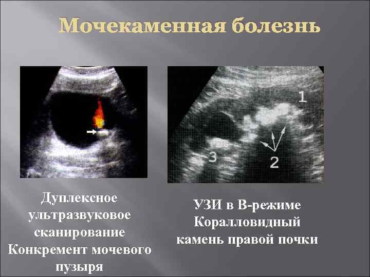 Узи картина мочекаменной болезни