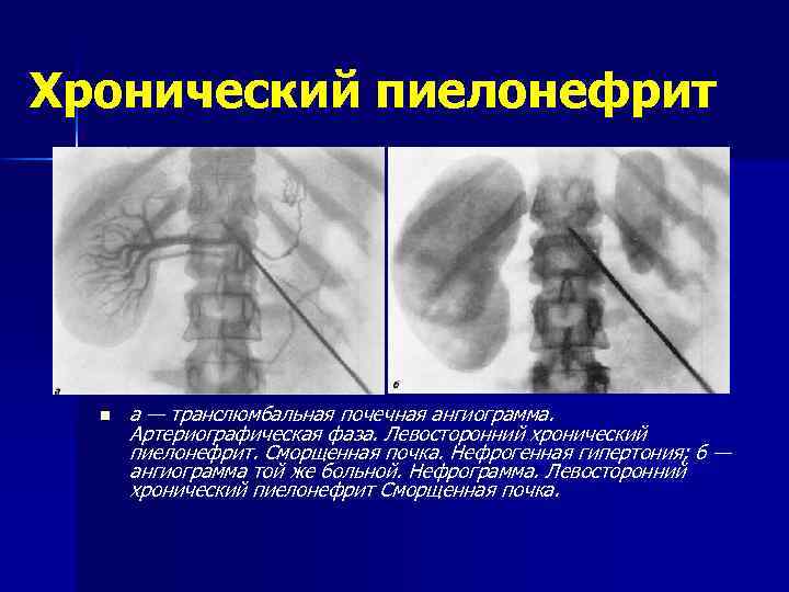 Лучевая диагностика мочевыделительной системы презентация