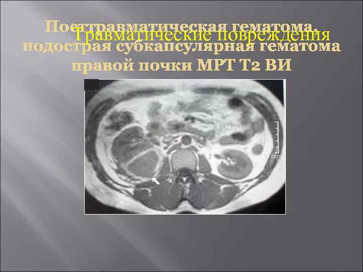 Посттравматическая гематома, Травматические повреждения подострая субкапсулярная гематома правой почки МРТ Т 2 ВИ 
