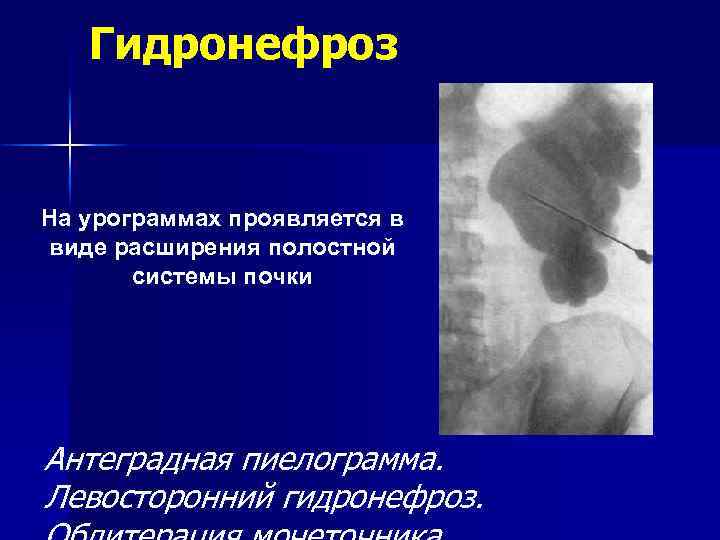 Гидронефроз На урограммах проявляется в виде расширения полостной системы почки Антеградная пиелограмма. Левосторонний гидронефроз.