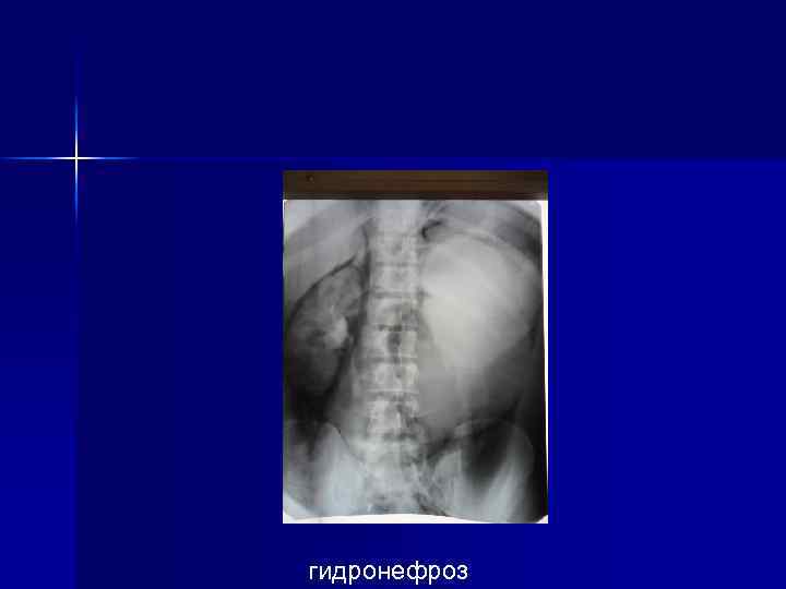 гидронефроз 
