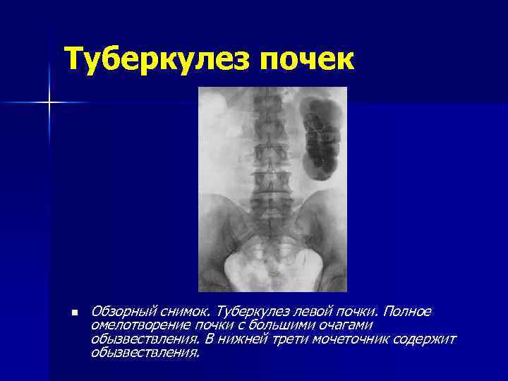 Презентация туберкулез мочевыделительной системы