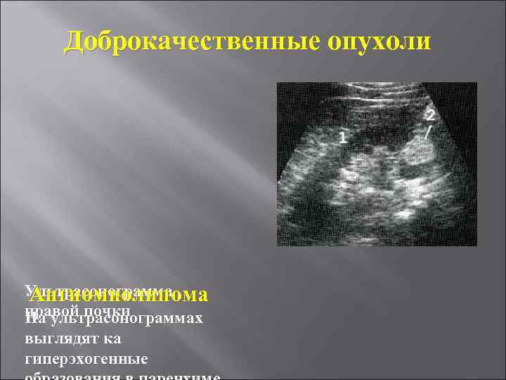 Доброкачественные опухоли Ультрасонограмма Ангиомиолипома правой почки На ультрасонограммах выглядят ка гиперэхогенные 
