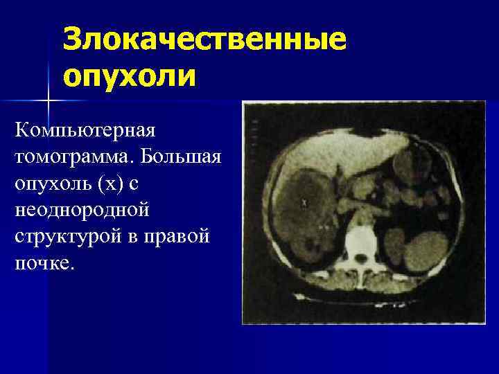 Кт картина образования правой почки