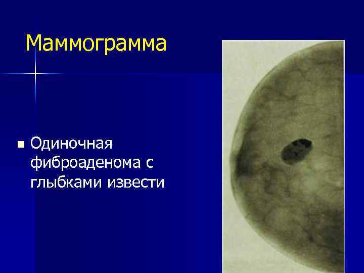 Маммограмма n Одиночная фиброаденома с глыбками извести 