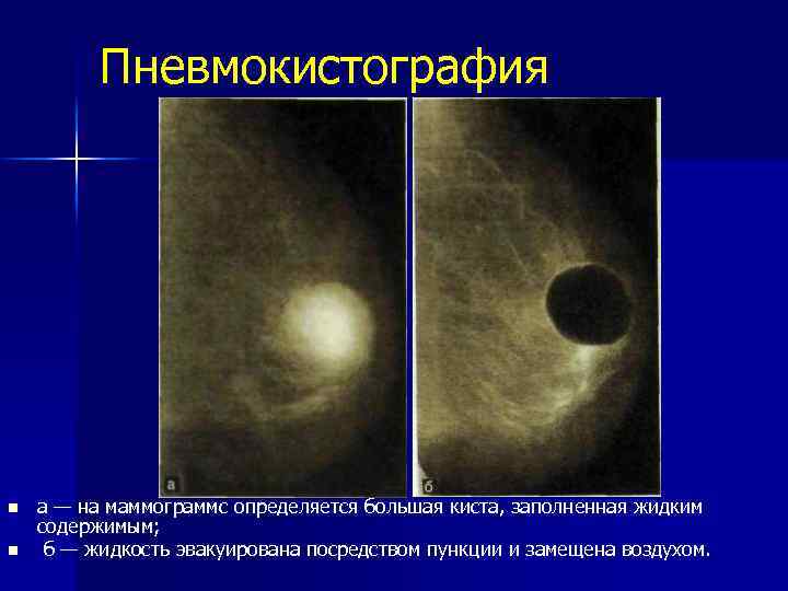 Пневмокистография n n а — на маммограммс определяется большая киста, заполненная жидким содержимым; б
