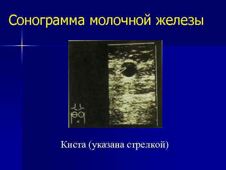 Сонограмма молочной железы Киста (указана стрелкой) 