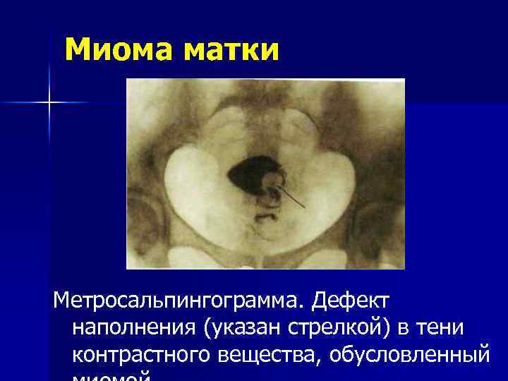 Миома матки Метросальпингограмма. Дефект наполнения (указан стрелкой) в тени контрастного вещества, обусловленный 