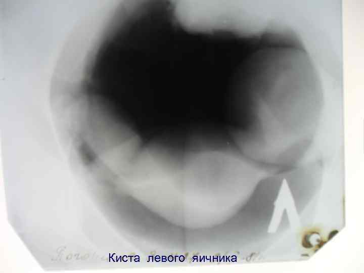 Киста левого яичника 