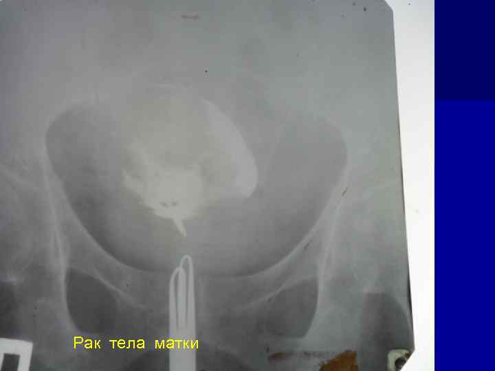 Рак тела матки 