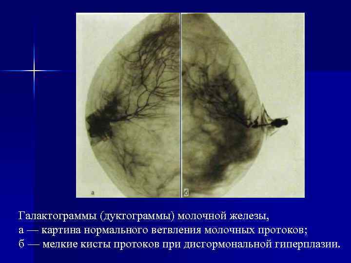 Rg картина диффузного фам молочных желез